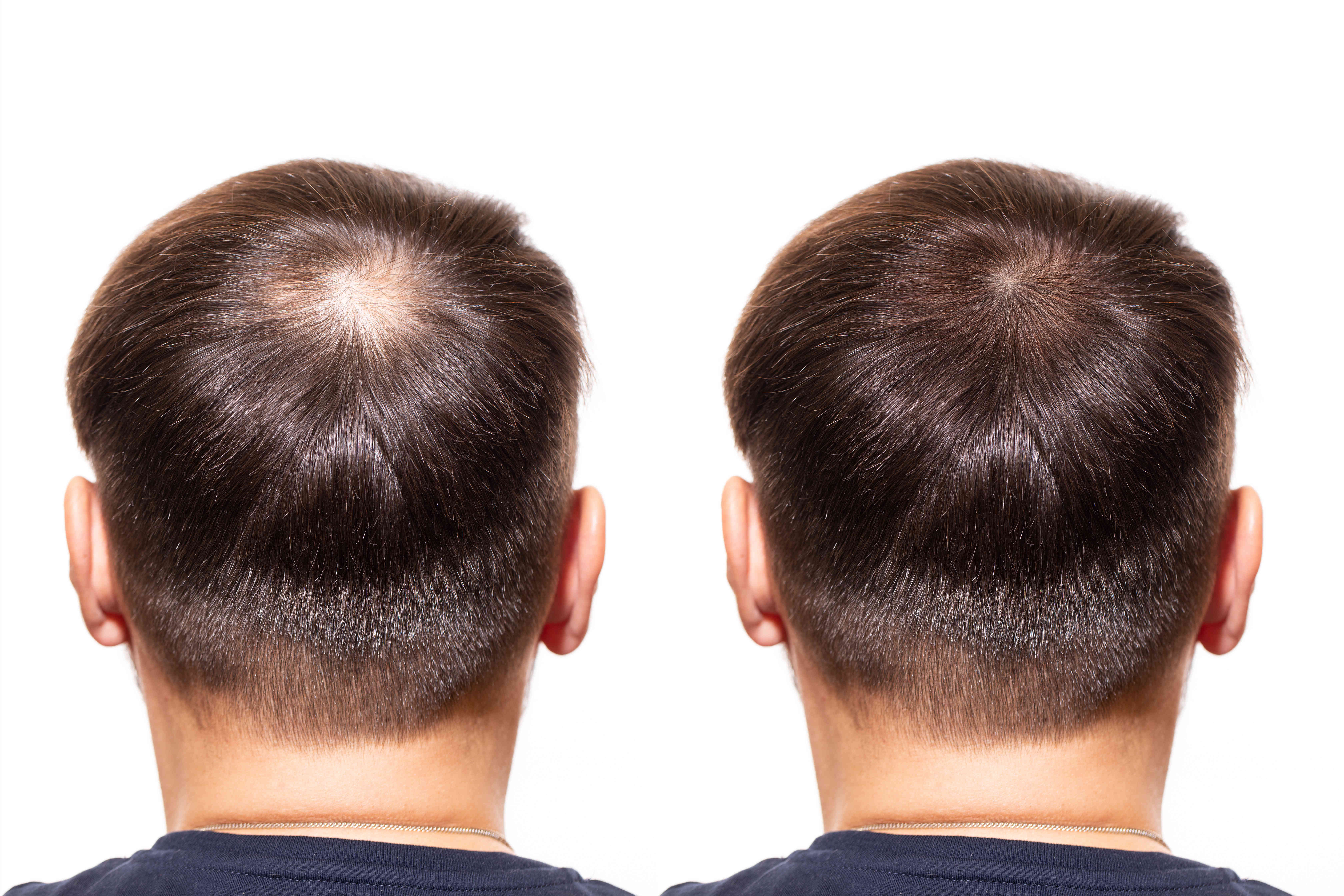Макушка волос у мужчин. Хайр мен мезотерапия для волос. Мезотерапия волос мужчин. Мезотерапия волос до и после.